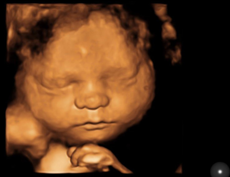 3d/4d ultrasound image