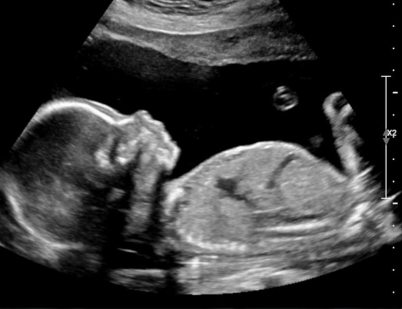 black and white ultrasound image