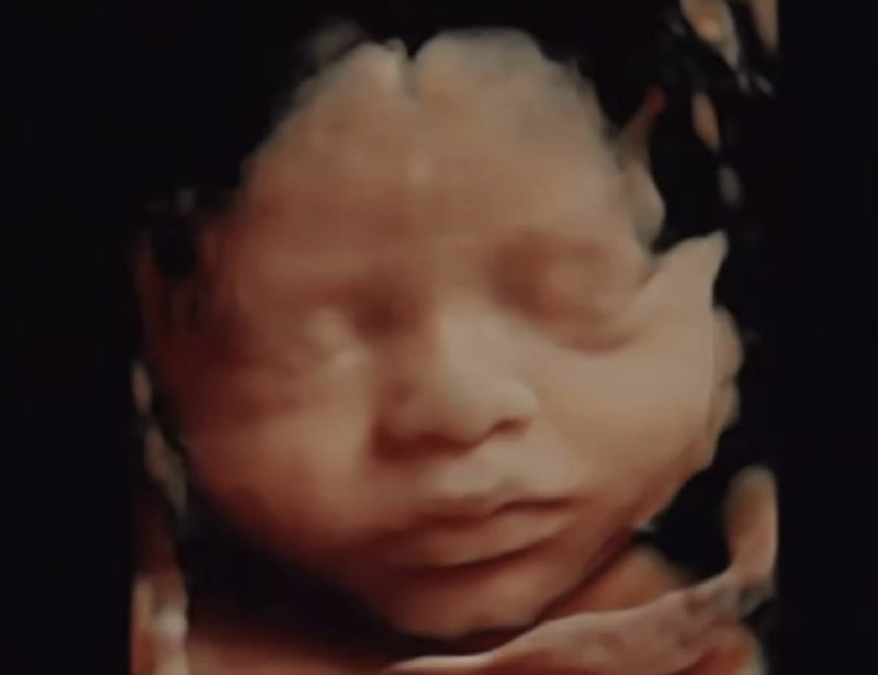 HD live ultrasound